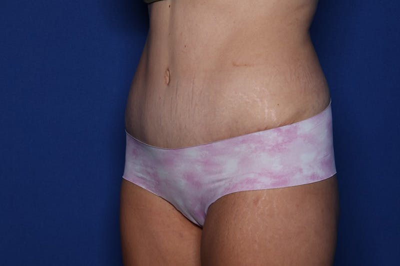 Tummy Tuck Before & After Gallery - Patient 396950 - Image 4