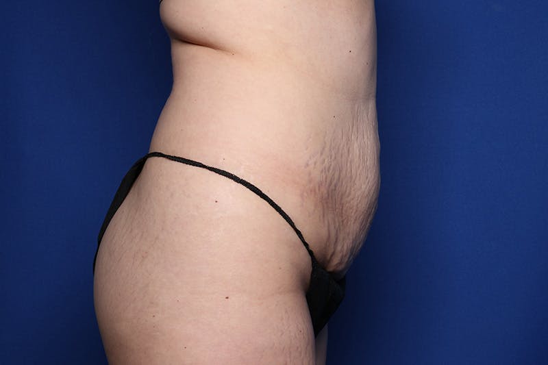 Tummy Tuck Before & After Gallery - Patient 396950 - Image 5