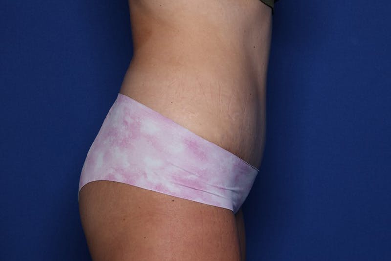 Tummy Tuck Before & After Gallery - Patient 396950 - Image 6