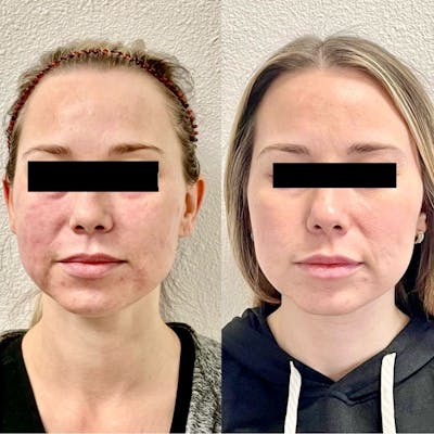 Sciton® Halo Before & After Gallery - Patient 293652 - Image 1