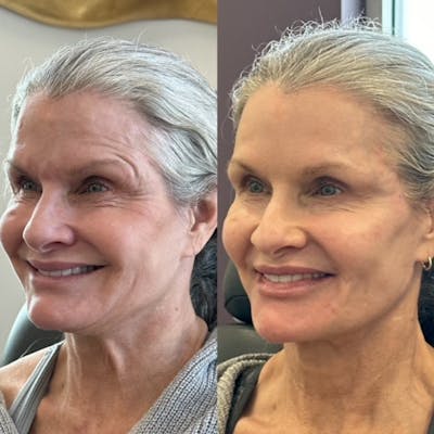 Jawline Filler Before & After Gallery - Patient 346941 - Image 1