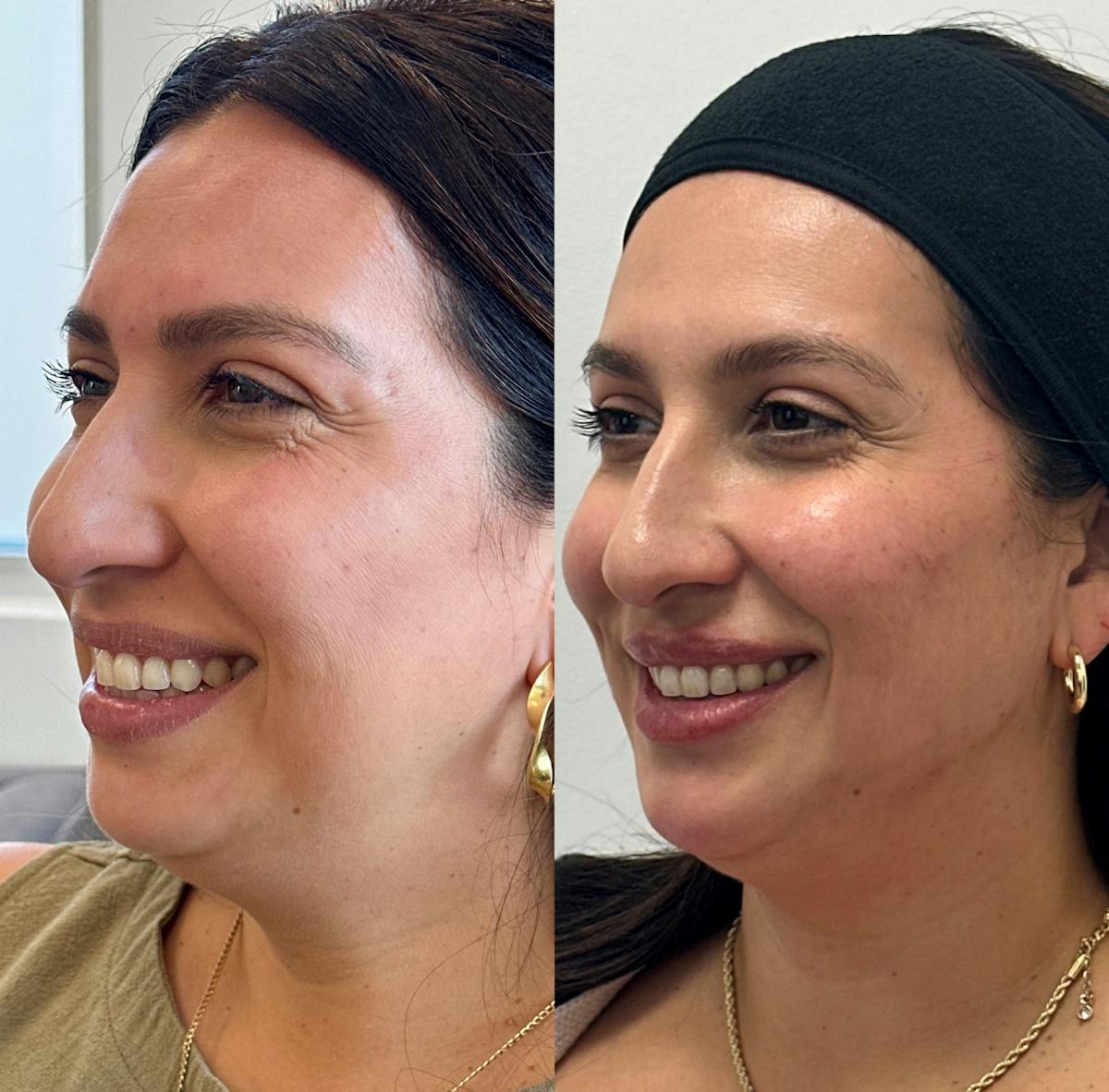 Jawline Filler Before & After Gallery - Patient 338415 - Image 2