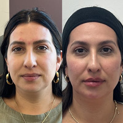 Cheek Filler Before & After Gallery - Patient 188401 - Image 1