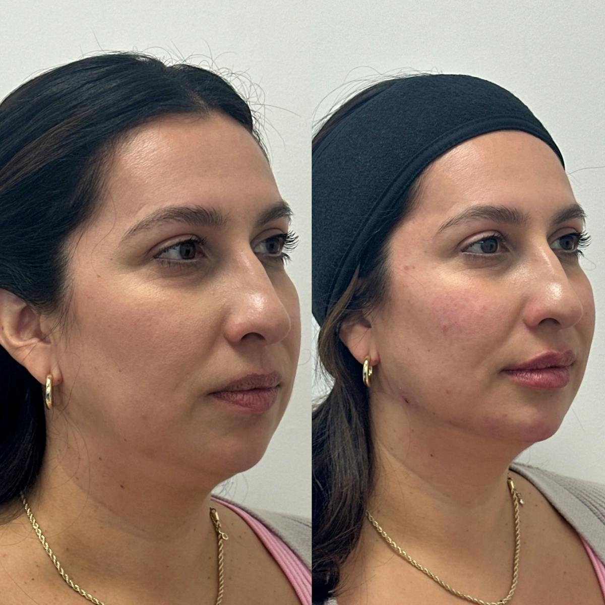 Cheek Filler Before & After Gallery - Patient 188401 - Image 3