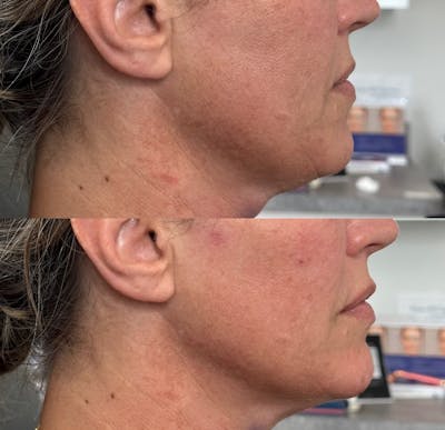 Jawline Filler Before & After Gallery - Patient 676886 - Image 1