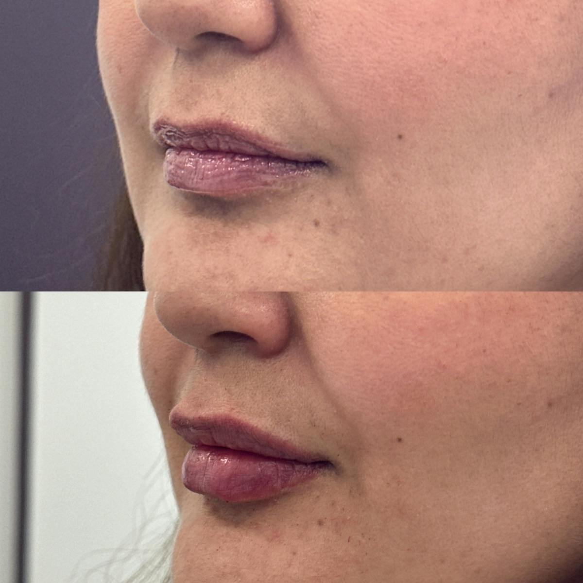 Lip Filler Before & After Gallery - Patient 481993 - Image 1