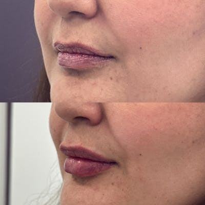 Lip Filler Before & After Gallery - Patient 481993 - Image 1