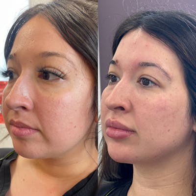 Lip Filler Before & After Gallery - Patient 205339 - Image 1