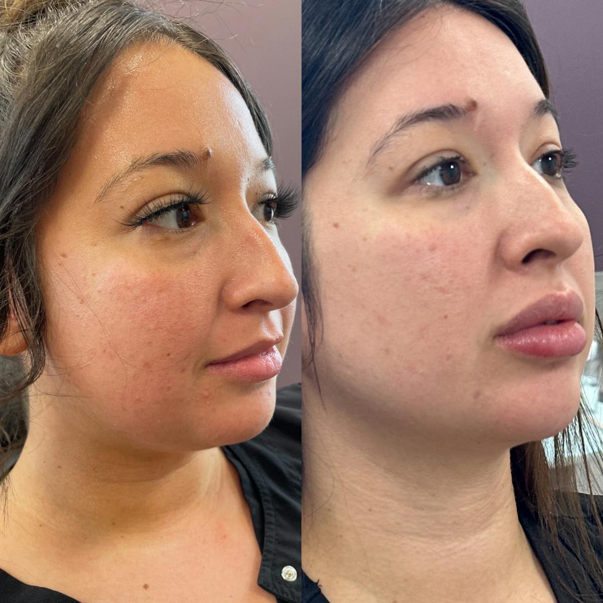 Cheek Filler Before & After Gallery - Patient 240689 - Image 2
