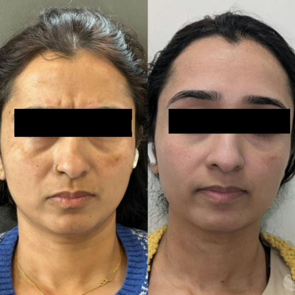 Microneedling with PRP Before & After Gallery - Patient 902871 - Image 1