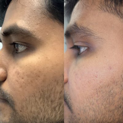 SkinPen® Microneedling Before & After Gallery - Patient 406977 - Image 1