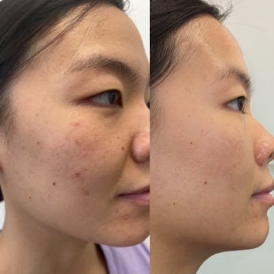 SkinPen® Microneedling Before & After Gallery - Patient 581638 - Image 1