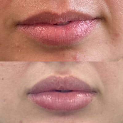 Lip Filler Before & After Gallery - Patient 412105 - Image 1