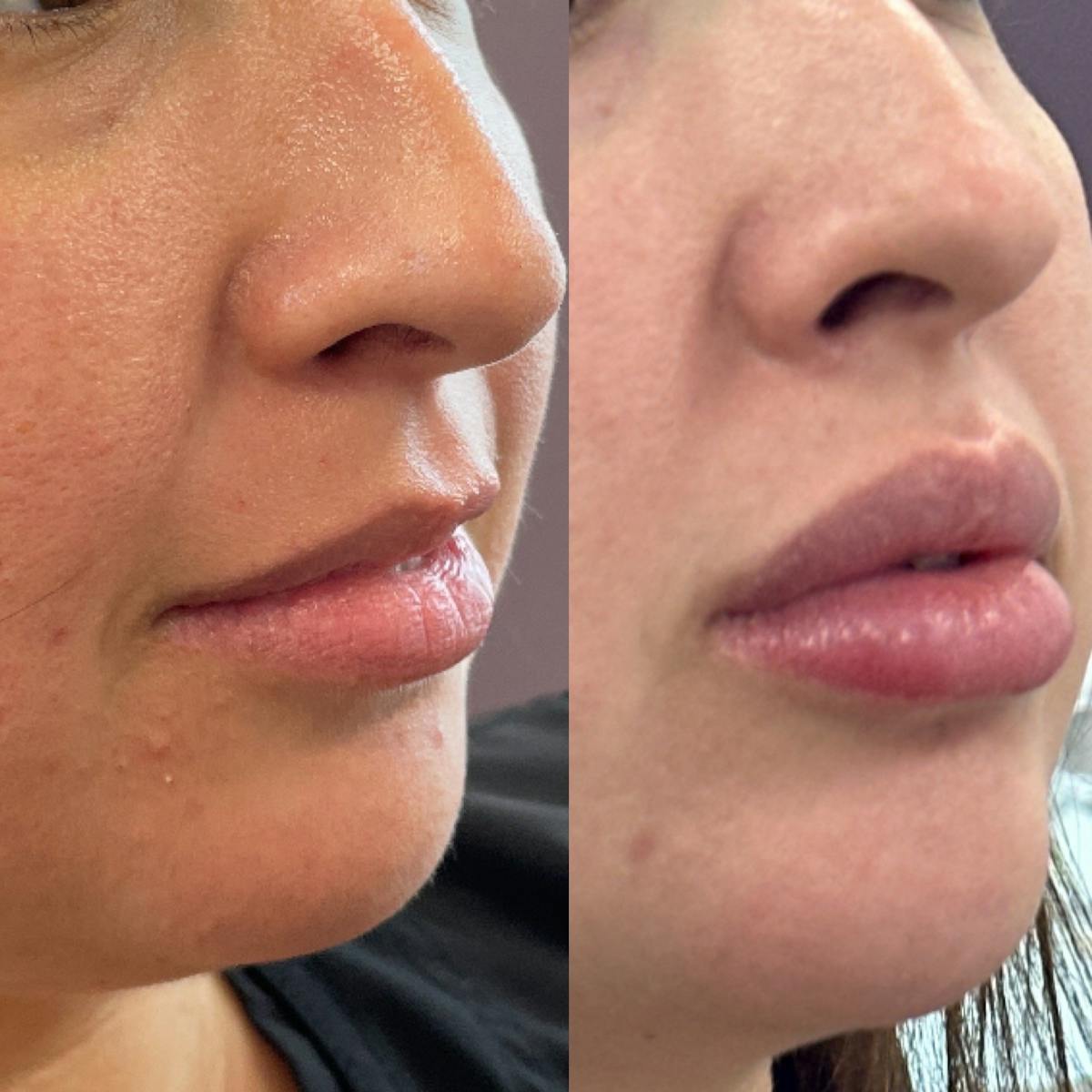 Lip Filler Before & After Gallery - Patient 412105 - Image 2