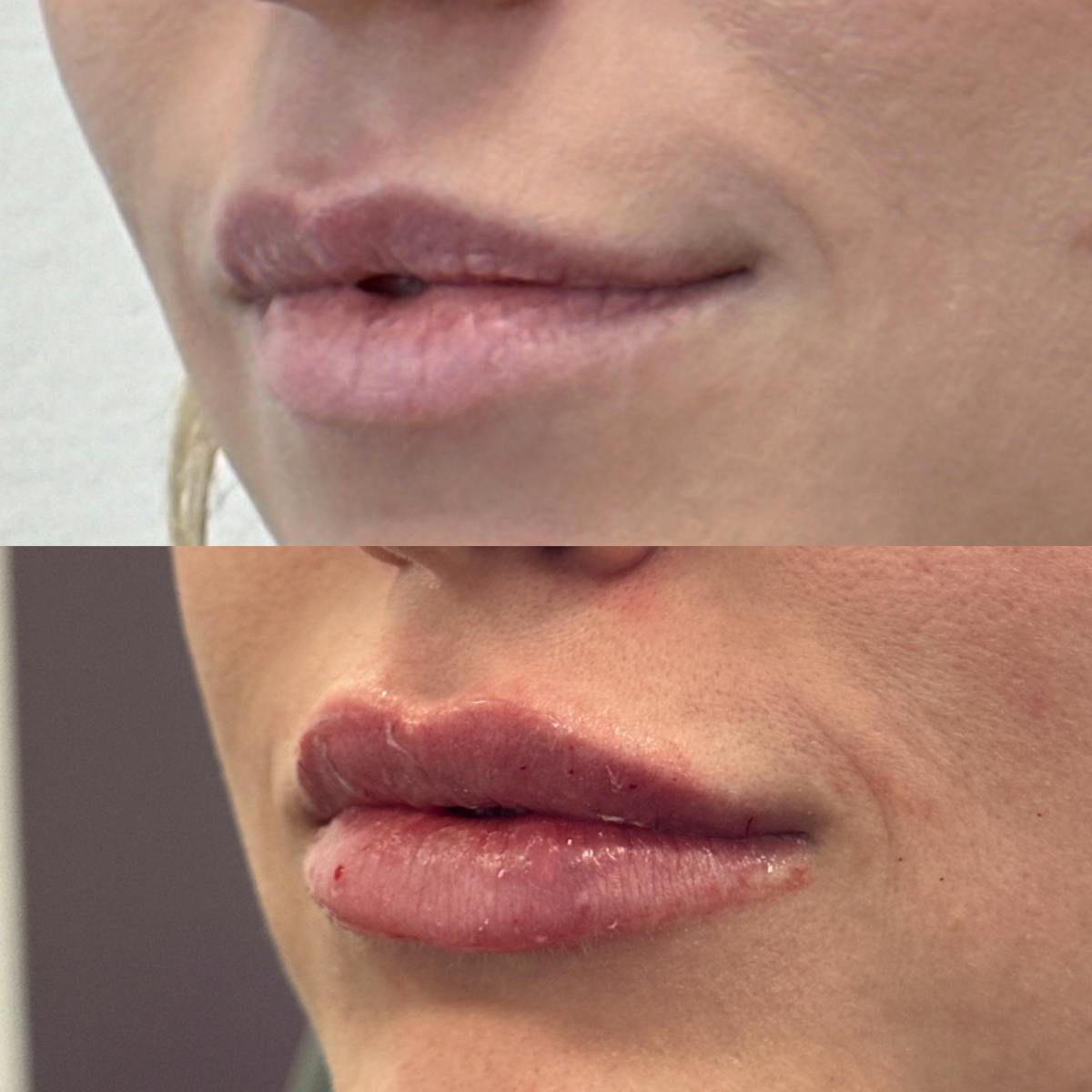 Lip Filler Before & After Gallery - Patient 325126 - Image 1