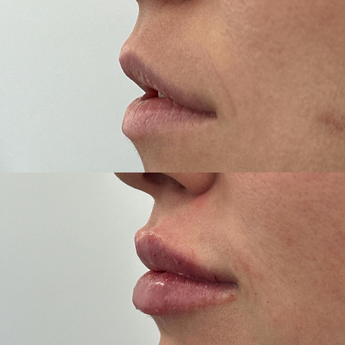 Lip Filler Before & After Gallery - Patient 325126 - Image 2