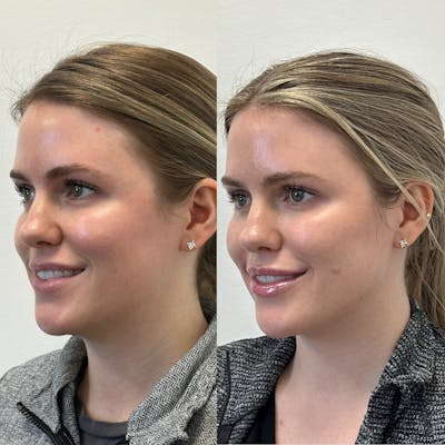Chin Filler Before & After Gallery - Patient 575042 - Image 1