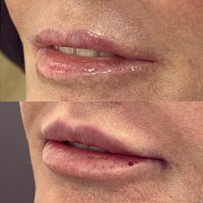 Lip Filler Before & After Gallery - Patient 109689 - Image 1