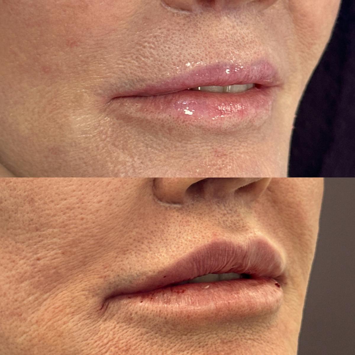 Lip Filler Before & After Gallery - Patient 109689 - Image 2