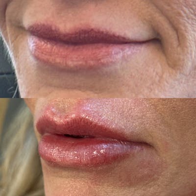 Lip Filler Before & After Gallery - Patient 241169 - Image 1