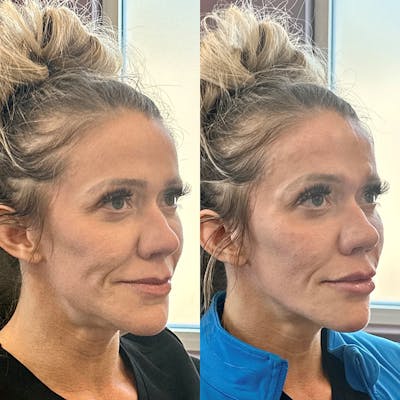 Cheek Filler Before & After Gallery - Patient 354850 - Image 1