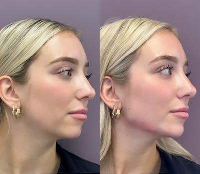 Jawline Filler Before & After Gallery - Patient 131454 - Image 1