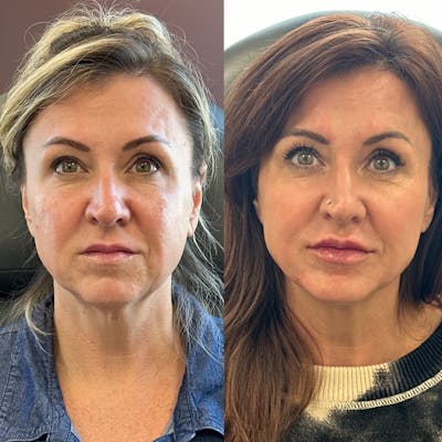BOTOX Before & After Gallery - Patient 317993 - Image 1