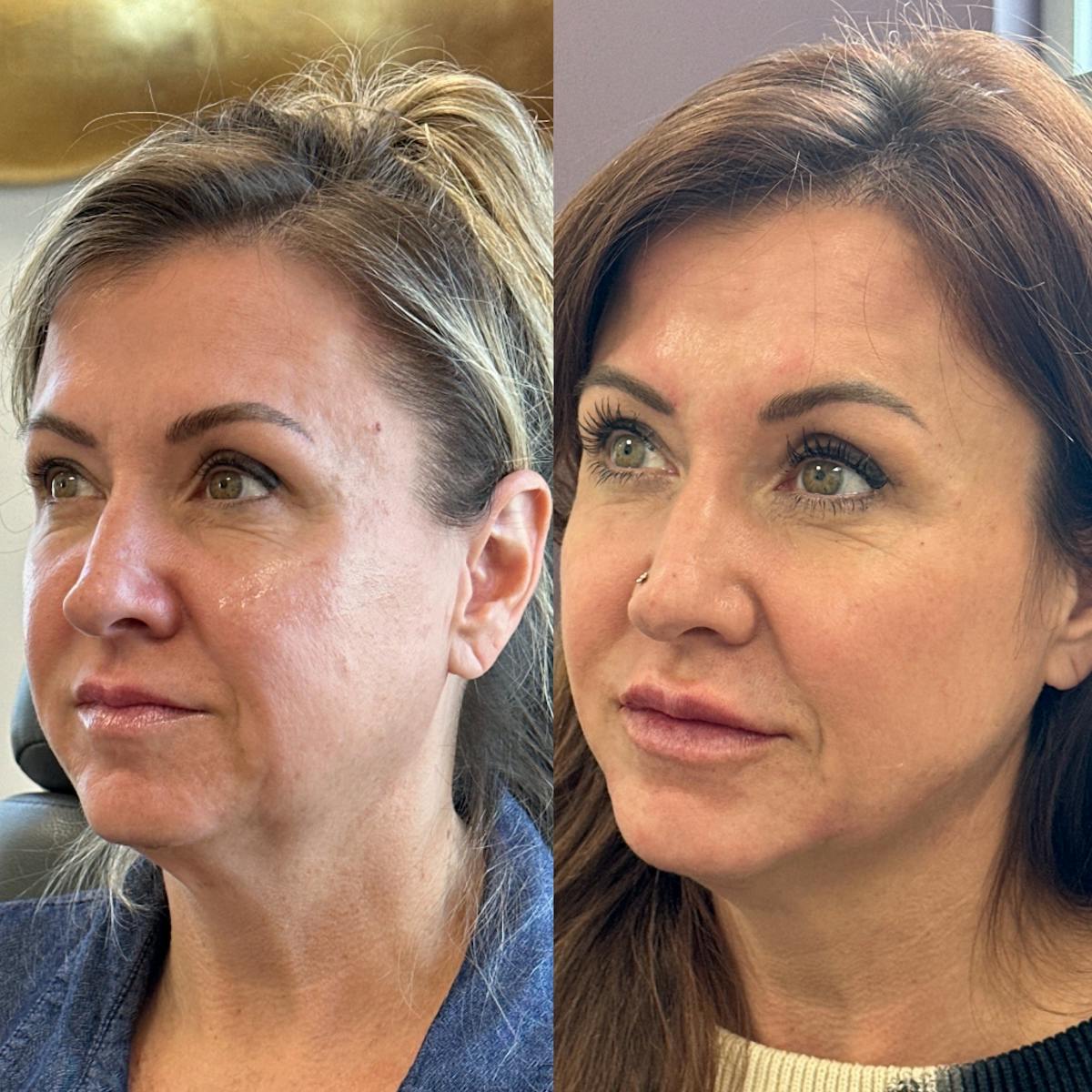 BOTOX Before & After Gallery - Patient 317993 - Image 2