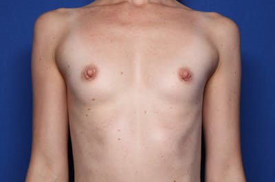 Breast Augmentation Before & After Gallery - Patient 168181 - Image 1