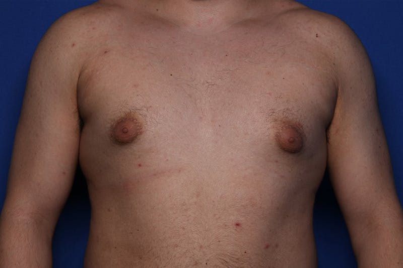 Gynecomastia (Male Breast Reduction) Before & After Gallery - Patient 433178 - Image 1