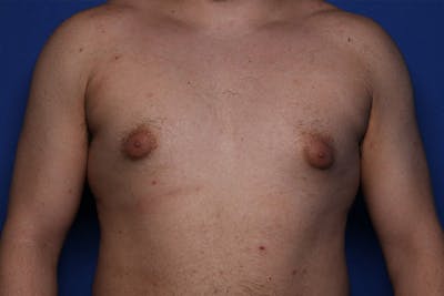 Gynecomastia (Male Breast Reduction) Before & After Gallery - Patient 433178 - Image 1