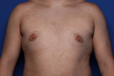 Gynecomastia (Male Breast Reduction) Before & After Gallery - Patient 433178 - Image 2
