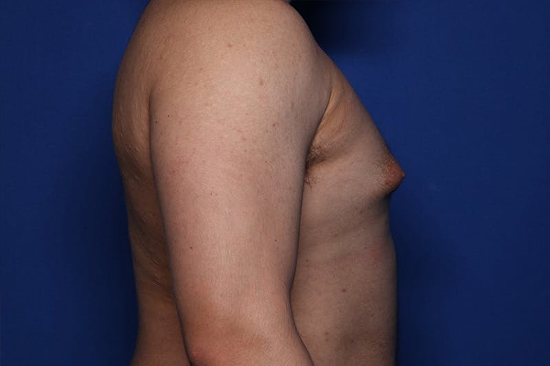 Gynecomastia (Male Breast Reduction) Before & After Gallery - Patient 433178 - Image 3