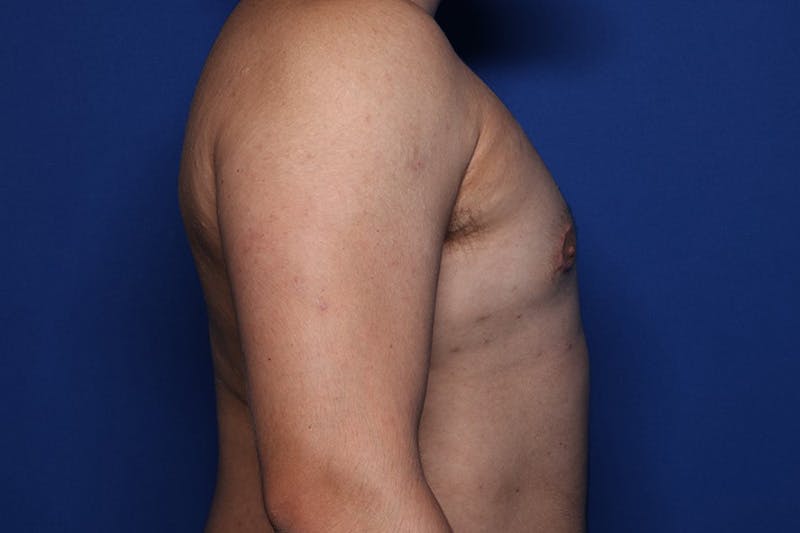 Gynecomastia (Male Breast Reduction) Before & After Gallery - Patient 433178 - Image 4