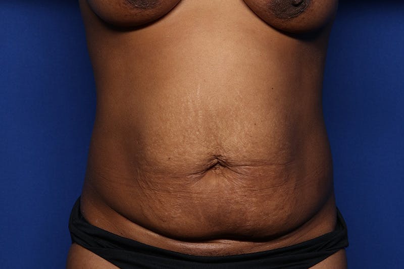 Tummy Tuck Before & After Gallery - Patient 293284 - Image 1