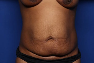 Tummy Tuck Before & After Gallery - Patient 293284 - Image 1