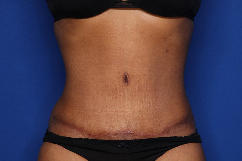 Tummy Tuck Before & After Gallery - Patient 293284 - Image 2