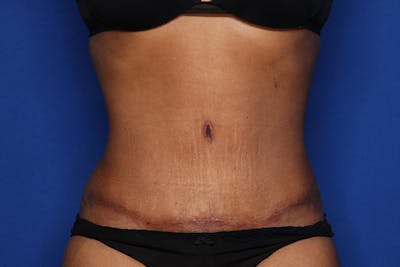 Tummy Tuck Before & After Gallery - Patient 293284 - Image 2