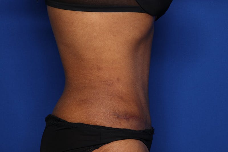 Tummy Tuck Before & After Gallery - Patient 293284 - Image 4