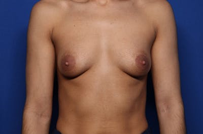 Breast Augmentation Before & After Gallery - Patient 212892 - Image 1