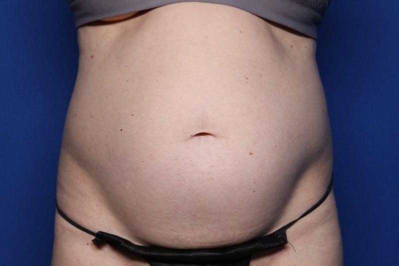 BodyTite™ Before and After Before & After Gallery - Patient 231394 - Image 1