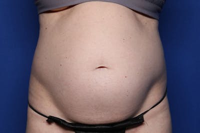 Liposuction Before & After Gallery - Patient 179285 - Image 1
