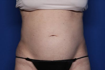 BodyTite™ Before & After Gallery - Patient 231394 - Image 2