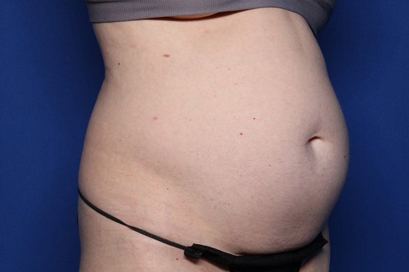 BodyTite™ Before and After Before & After Gallery - Patient 231394 - Image 3