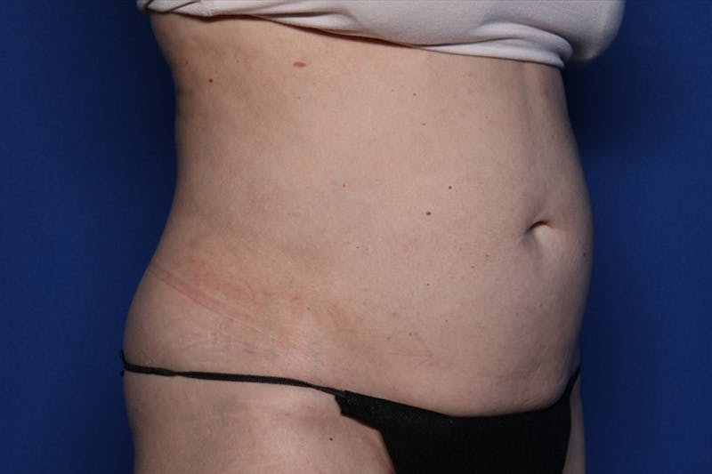 BodyTite™ Before and After Before & After Gallery - Patient 231394 - Image 4