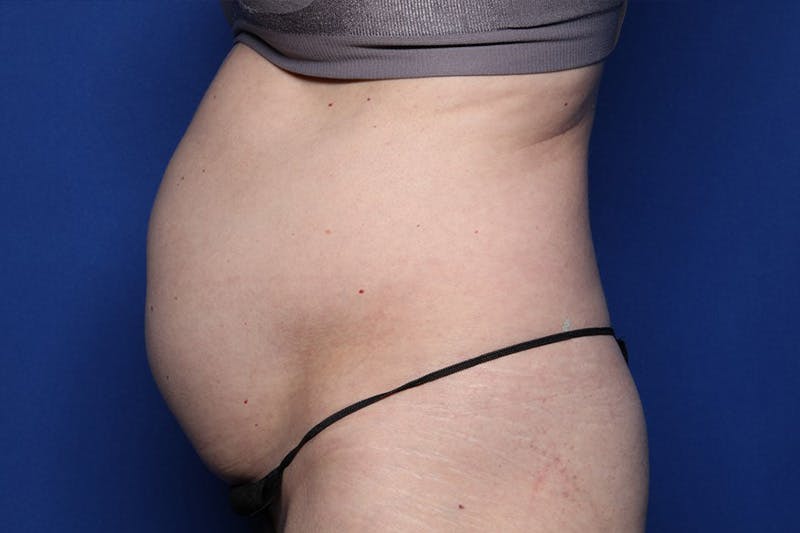 BodyTite™ Before and After Before & After Gallery - Patient 231394 - Image 5