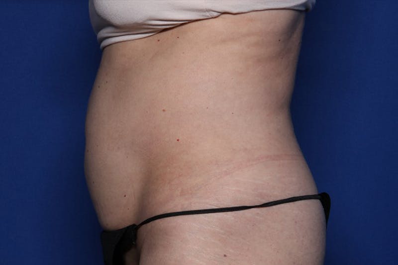 Liposuction Before & After Gallery - Patient 179285 - Image 6