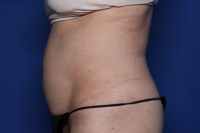 BodyTite™ Before and After Before & After Gallery - Patient 231394 - Image 6