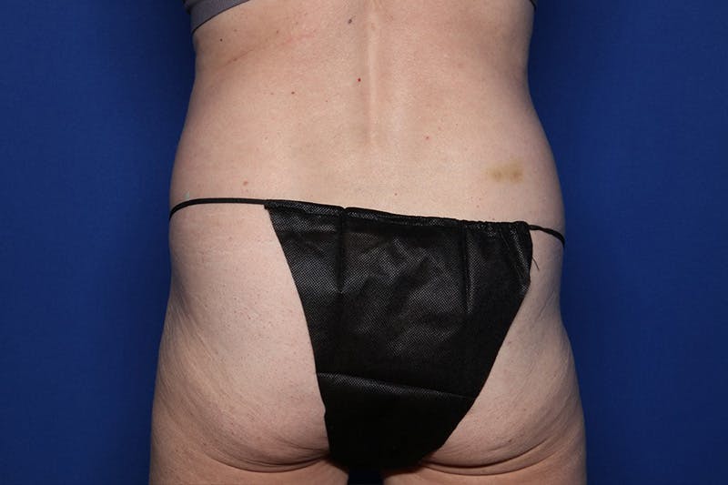 BodyTite™ Before and After Before & After Gallery - Patient 231394 - Image 7