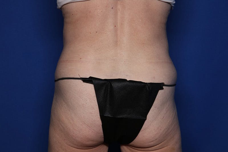 BodyTite™ Before and After Before & After Gallery - Patient 231394 - Image 8